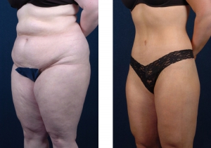 Body Sculpting after weight Loos.