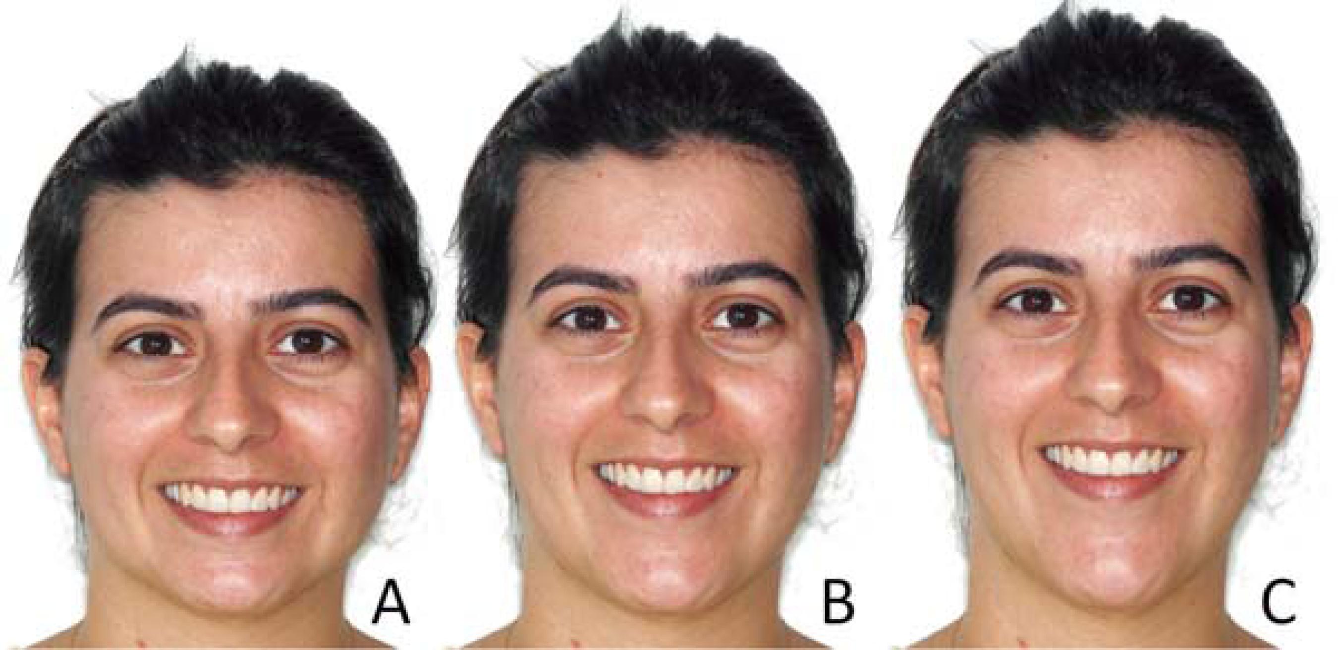 Botox and Fillers in Lahore Pakistan