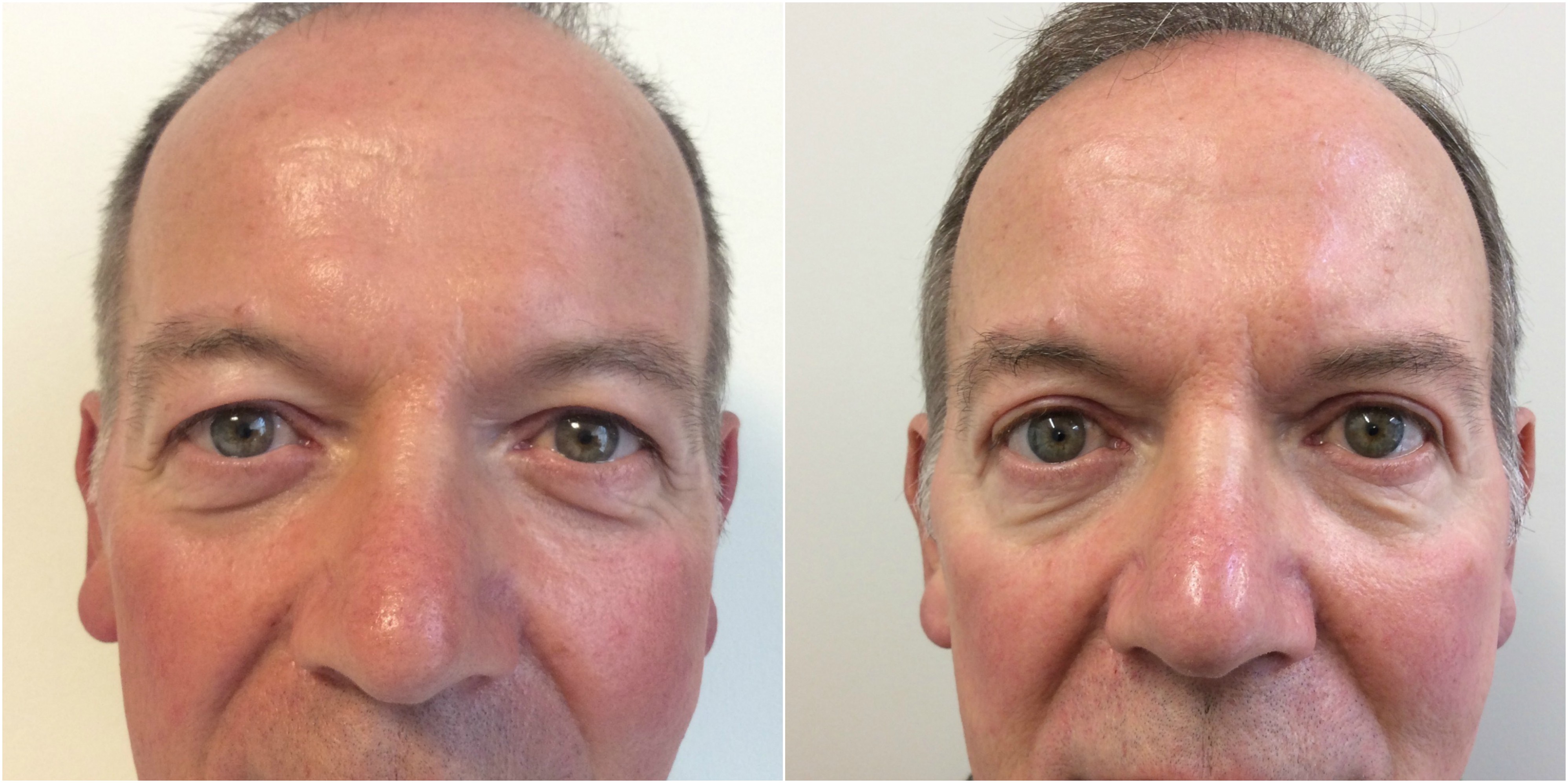 Blepharoplasty Lahore Pakistan