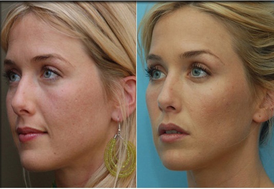 Cheek Implants