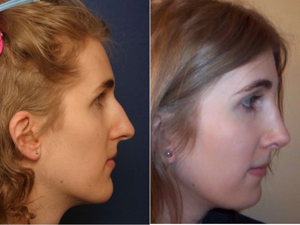 Chin Reduction