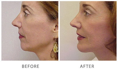 Botox and Fillers in Lahore Pakistan