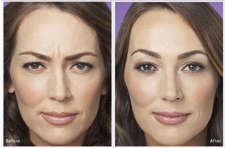 Botox and Fillers in Lahore Pakistan