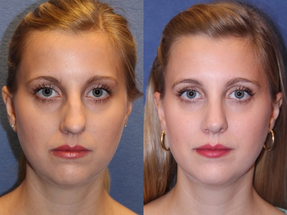Botox and Fillers in Lahore Pakistan