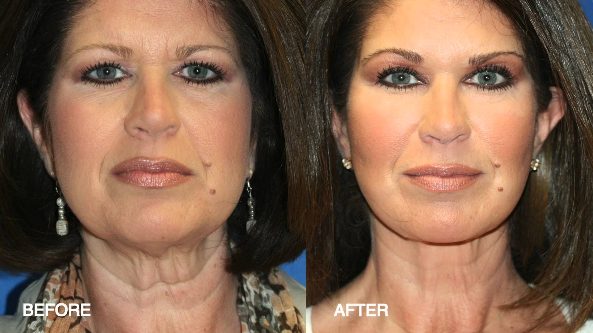 Fat Grafting and Fat Injection