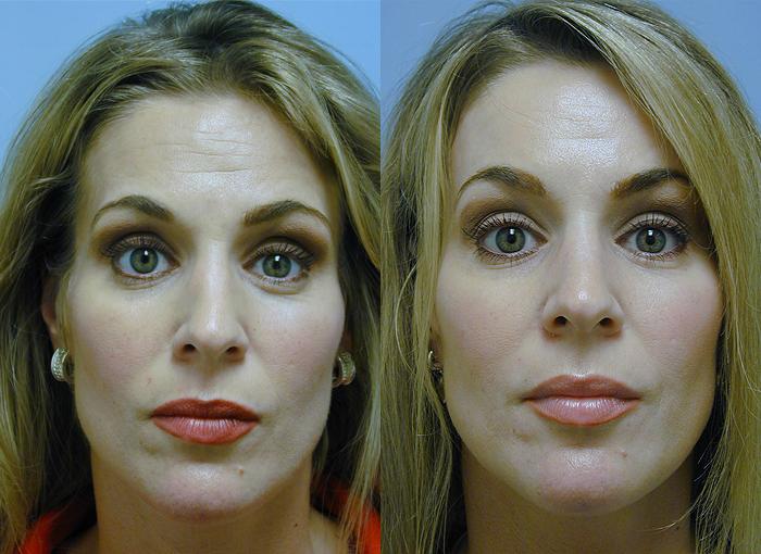 forehead lift