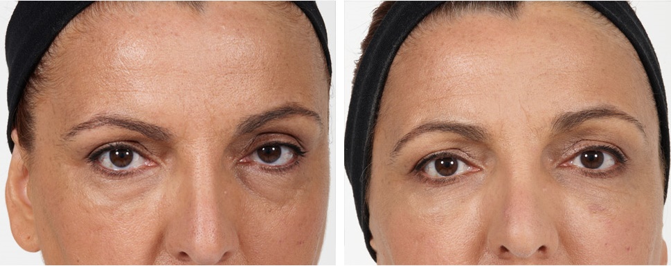 Botox and Fillers in Lahore Pakistan