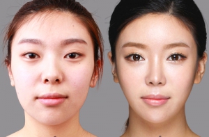 Botox and Fillers in Lahore Pakistan