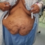 tummy tuck