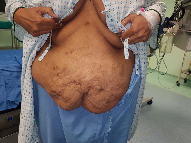 tummy tuck