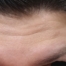 Botox