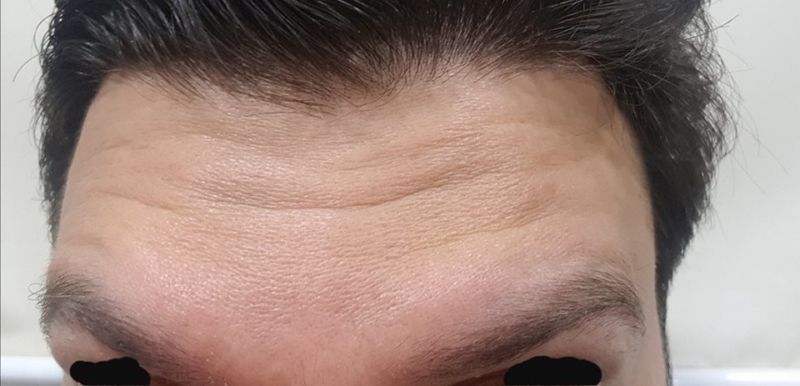 Botox
