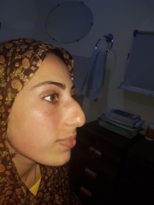 Rhinoplasty