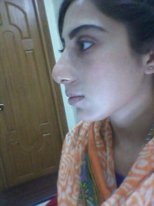Rhinoplasty