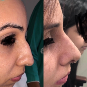 Rhinoplasty by Dr Sheraz Raza