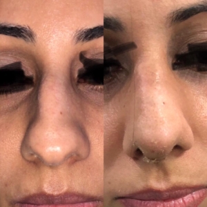Rhinoplasty by Dr Sheraz Raza