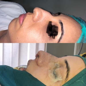 Rhinoplasty by Dr Sheraz Raza
