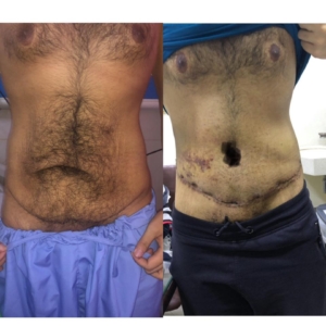 tummy tuck by Dr Sheraz Raza
