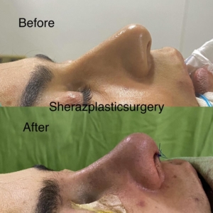 Dr Sheraz Raza Rhinoplasty Surgeon