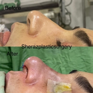 Dr Sheraz Raza Rhinoplasty Surgeon
