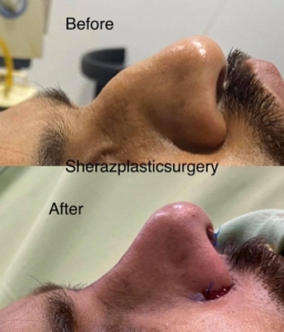 Dr Sheraz Raza Rhinoplasty Surgeon