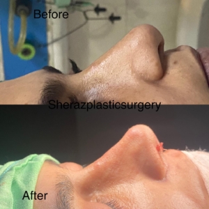 Dr Sheraz Raza Rhinoplasty Surgeon