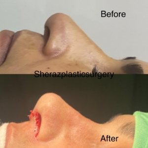 Dr Sheraz Raza Rhinoplasty Surgeon