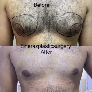 Dr Sheraz Raza Breast Reduction