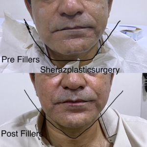 Dr Sheraz Raza jawline