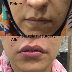 Dr Sheraz Raza Lips Fillers