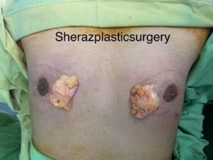 Dr Sheraz Raza Breast Reduction