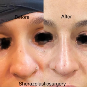 Dr Sheraz Raza Rhinoplasty Surgeon
