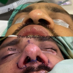 Dr Sheraz Raza Rhinoplasty Surgeon