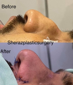 Dr Sheraz Raza Rhinoplasty Surgeon