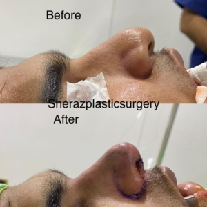 Dr Sheraz Raza Rhinoplasty Surgeon