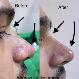 Dr Sheraz Raza Rhinoplasty Surgeon