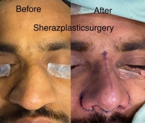 Dr Sheraz Raza Rhinoplasty Surgeon