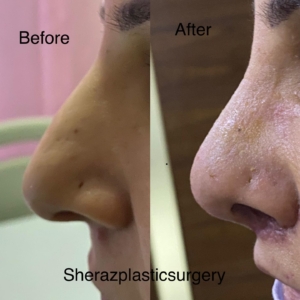 Dr Sheraz Raza Rhinoplasty Surgeon
