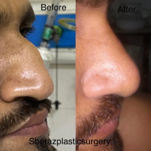 Dr Sheraz Raza Rhinoplasty Surgeon