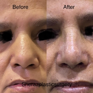 Dr Sheraz Raza Rhinoplasty Surgeon