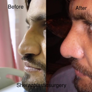 Dr Sheraz Raza Rhinoplasty Surgeon