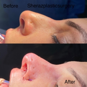 Dr Sheraz Raza Rhinoplasty Surgeon