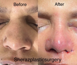 Dr Sheraz Raza Rhinoplasty Surgeon