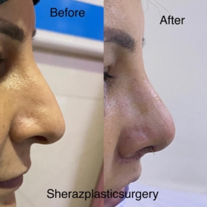 Dr Sheraz Raza Rhinoplasty Surgeon