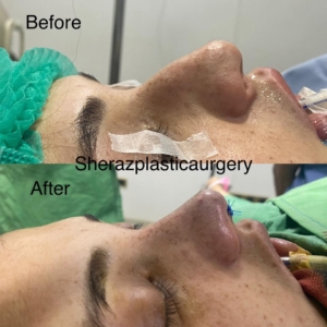 Dr Sheraz Raza Rhinoplasty Surgeon