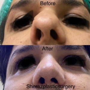 Dr Sheraz Raza Rhinoplasty Surgeon
