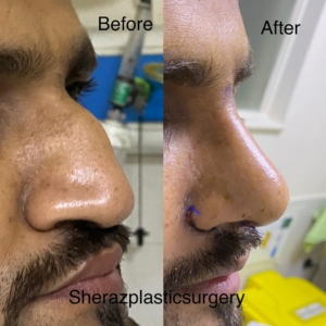 Dr Sheraz Raza Rhinoplasty Surgeon