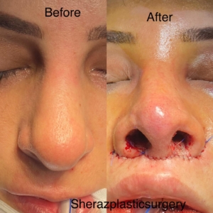 Dr Sheraz Raza Rhinoplasty Surgeon