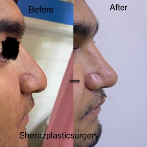 Dr Sheraz Raza Rhinoplasty Surgeon