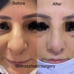 Dr Sheraz Raza Rhinoplasty Surgeon